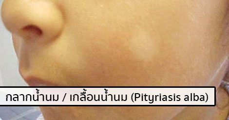 กลากน้ำนม (เกลื้อนน้ำนม) อาการ สาเหตุ การรักษาโรคกลากน้ำนม 5 วิธี !