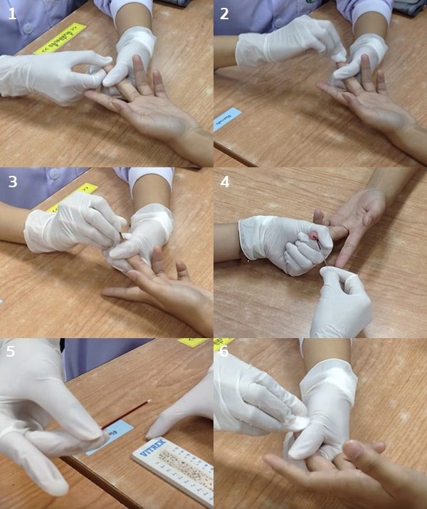 การตรวจระดับน้ำตาลในเลือด