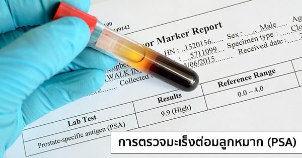การตรวจมะเร็งต่อมลูกหมาก (PSA : Prostate Specific Antigen)