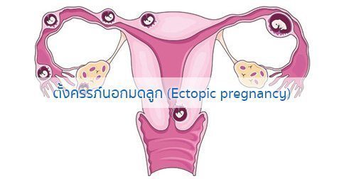 ท้องนอกมดลูก : สาเหตุ การรักษา อาการตั้งครรภ์นอกมดลูก ฯลฯ