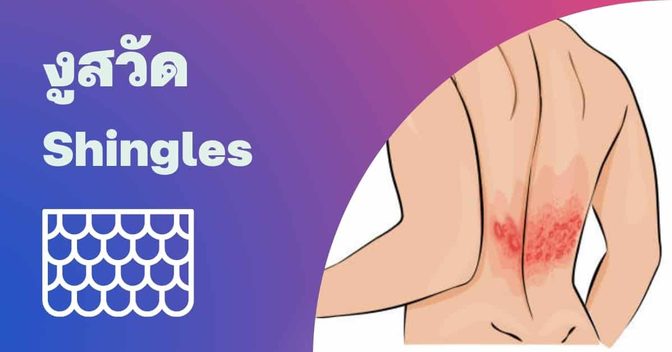 โรคงูสวัด (Shingles) อาการ, สาเหตุ, การรักษา ฯลฯ