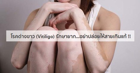 โรคด่างขาว อาการ สาเหตุ และการรักษาโรคด่างขาว 10 วิธี !!