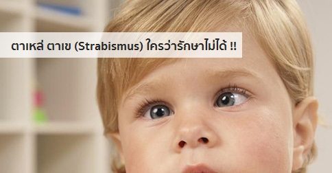 ตาเหล่ (ตาเข) อาการ สาเหตุ และการรักษาตาเหล่ 10 วิธี !!
