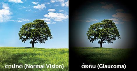 ต้อหิน (Glaucoma) อาการ สาเหตุ และการรักษาโรคต้อหิน 5 วิธี !!
