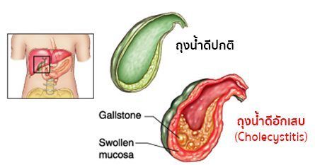 ถุงน้ำดีอักเสบ (Cholecystitis) อาการ สาเหตุ การรักษาถุงน้ําดีอักเสบ 5 วิธี !!