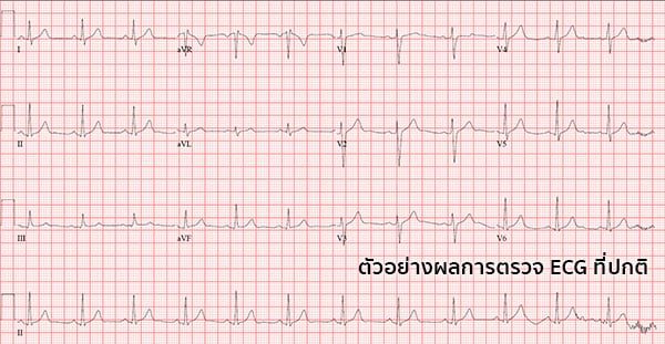 ผลการตรวจคลื่นไฟฟ้าหัวใจ