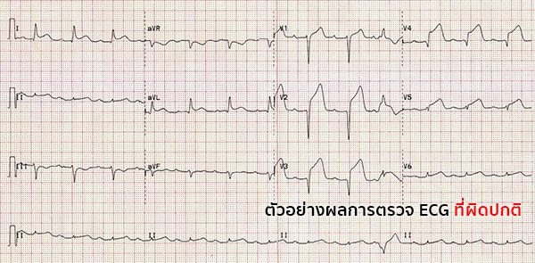 ผลตรวจคลื่นไฟฟ้าหัวใจ