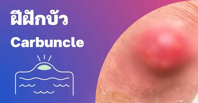 ฝีฝักบัว (Carbuncle) อาการ, สาเหตุ, การรักษา ฯลฯ