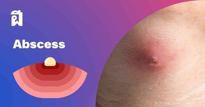 ฝี (Abscess) สาเหตุ, อาการ, การรักษา,สมุนไพรรักษาฝี ฯลฯ