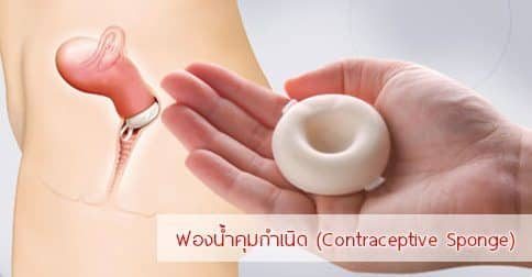 ฟองน้ำคุมกำเนิด : 11 ข้อดี-ข้อเสีย & วิธีการใส่ฟองน้ำคุมกำเนิด !!