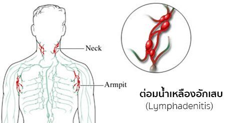 ต่อมน้ำเหลืองอักเสบ อาการ สาเหตุ และวิธีรักษาต่อมน้ำเหลืองอักเสบ 3 วิธี !!