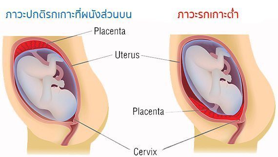 ภาวะรกเกาะต่ำ