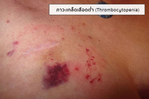 ภาวะเกล็ดเลือดต่ำ