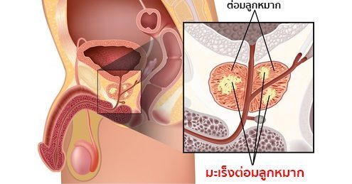 มะเร็งต่อมลูกหมาก อาการ สาเหตุ และการรักษามะเร็งต่อมลูกหมาก 9 วิธี !