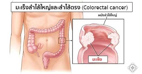 มะเร็งลําไส้ อาการ สาเหตุ การรักษาโรคมะเร็งลำไส้ใหญ่ 5 วิธี !