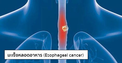 มะเร็งหลอดอาหาร อาการ สาเหตุ การรักษาโรคมะเร็งหลอดอาหาร 7 วิธี !