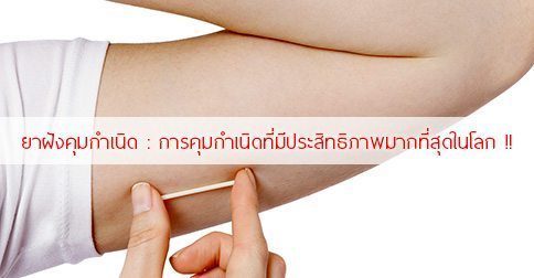 ยาฝังคุมกำเนิด : 14 ข้อดี-ข้อเสีย & การฝังยาคุมกำเนิด !!
