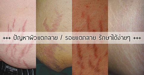 13 วิธีรักษาผิวแตกลาย & ลดรอยแตกลายอย่างได้ผล !!