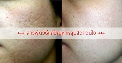 18 วิธีรักษาหลุมสิว ! หน้าเป็นหลุมสิวทำไงดี ??