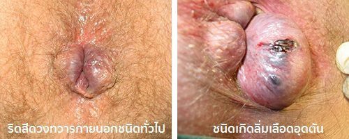 ริดสีดวงภายนอก