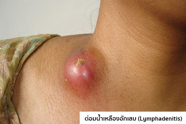 รูปต่อมน้ำเหลืองอักเสบ
