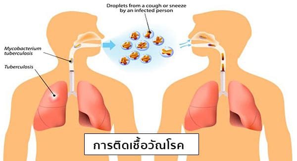 วัณโรคติดต่อทางไหนบ้าง