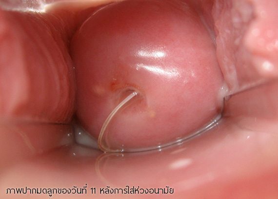 วิธีการใส่ห่วงอนามัยคุมกําเนิด