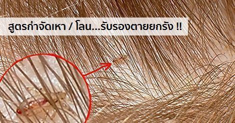 เหา โลน อาการ สาเหตุ และการกำจัดเหา-โลน 14 วิธี !!