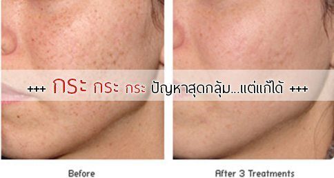 10 วิธีรักษากระ ! กระบนใบหน้ารักษายังไง ??