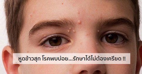 หูดข้าวสุก อาการ สาเหตุ และการรักษาโรคหูดข้าวสุก 20 วิธี !!