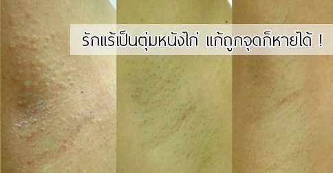 8 วิธีแก้รักแร้หนังไก่ ! รักแร้เป็นหนังไก่ทำไงดี ??