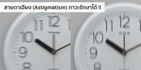 สายตาเอียง อาการ สาเหตุ และการรักษาสายตาเอียง 5 วิธี !!