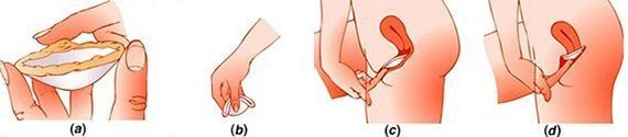 วิธีใส่ฝาครอบปากมดลูก
