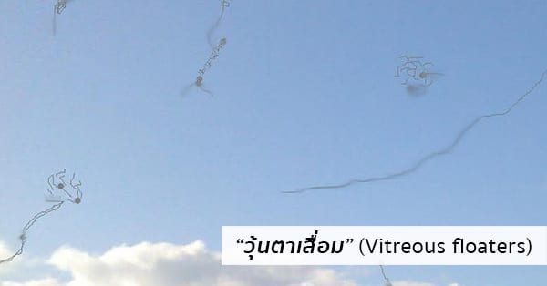 วุ้นตาเสื่อม (มองเห็นจุดดําลอยไปมา) อาการ, สาเหตุ, การรักษา ฯลฯ