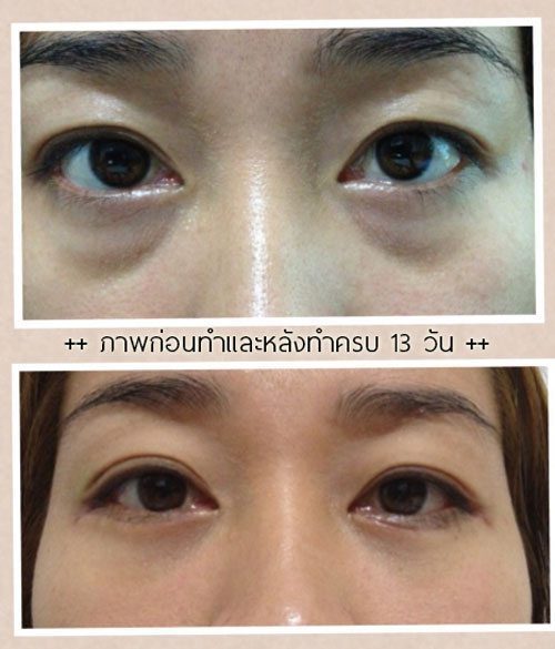 ศัลยกรรมถุงใต้ตา