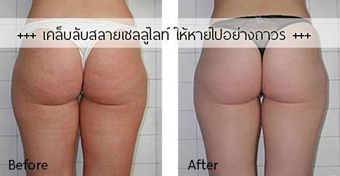 16 วิธีลดเซลลูไลท์และสาเหตุการเกิดเซลลูไลท์ ! (Cellulite)