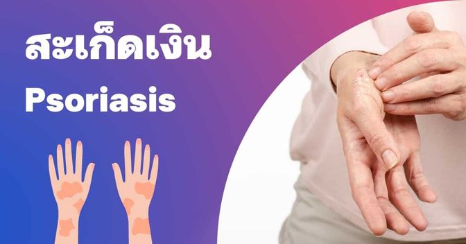 สะเก็ดเงิน (Psoriasis) สาเหตุ, อาการ, การรักษา ฯลฯ