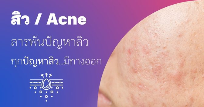 สิว (Acne)