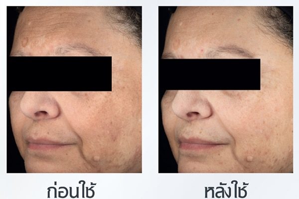ผลิตภัณฑ์อัลตร้าไวท์ เดย์ฟลูอิด ของ Eucerin ที่มีสาร THIAMIDOL™ เป็นเวลา 4 สัปดาห์