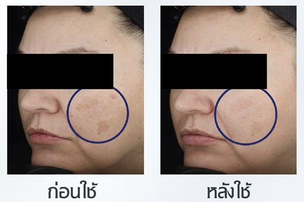 หลังใช้สารไทอามิดอล