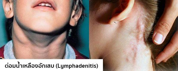 อาการต่อมน้ำเหลืองอักเสบ