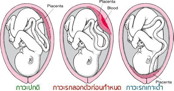 อาการรกลอกตัวก่อนกำหนด