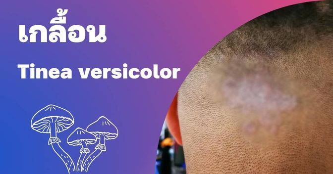 เกลื้อน (Tinea versicolor) สาเหตุ, อาการ, การรักษา ฯลฯ