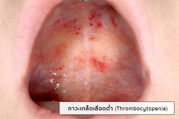 เกล็ดเลือดต่ำเกิดจากอะไร
