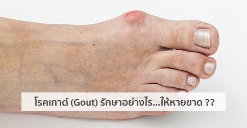 โรคเกาต์ อาการ สาเหตุ และการรักษาโรคเกาต์ 19 วิธี !!