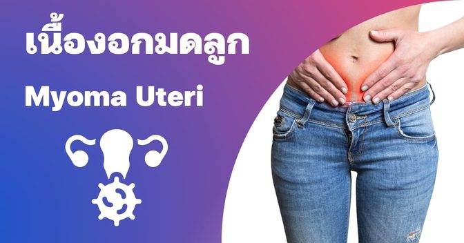 เนื้องอกมดลูก (Myoma uteri) อาการ, สาเหตุ, การรักษา ฯลฯ
