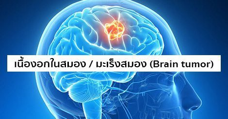 เนื้องอกสมอง / มะเร็งสมอง อาการ สาเหตุ การรักษาโรคเนื้องอกในสมอง 5 วิธี !
