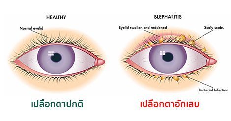 เปลือกตาอักเสบ (Blepharitis) อาการ สาเหตุ การรักษาเปลือกตาอักเสบ 8 วิธี !!