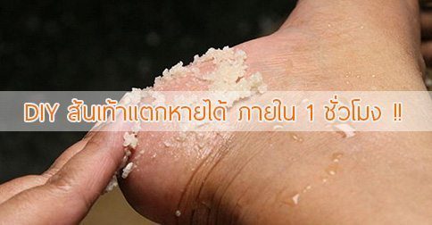 17 วิธีรักษาส้นเท้าแตก ! ส้นเท้าแตกทําไงดี ??