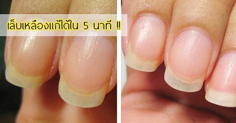 15 วิธีแก้เล็บเหลือง ! มีปัญหาเล็บเหลืองทําไงดี ?